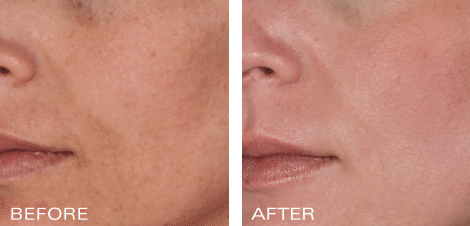 Ossential® Aggressive Anti-Aging Program