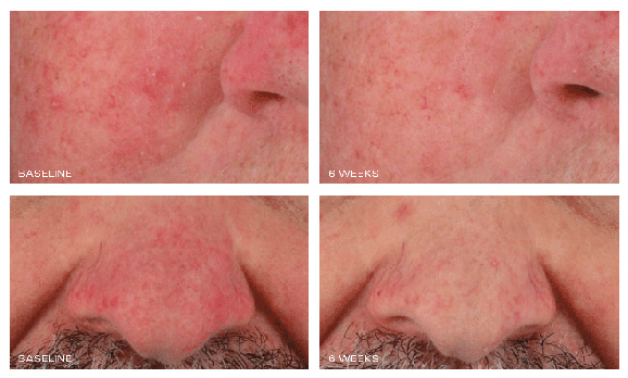 Rozatrol® - Patient Grading Before & After