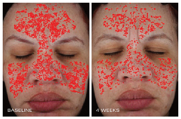 Instant Pore Refiner - Pore Size Before & After