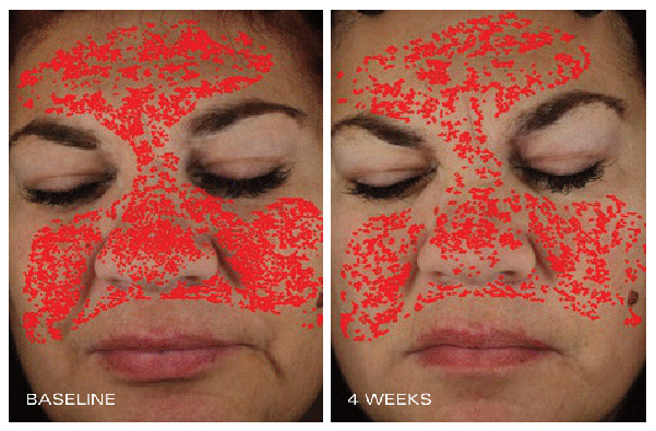 Instant Pore Refiner - Pore Size Before & After