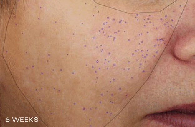 Pore Reduction - After