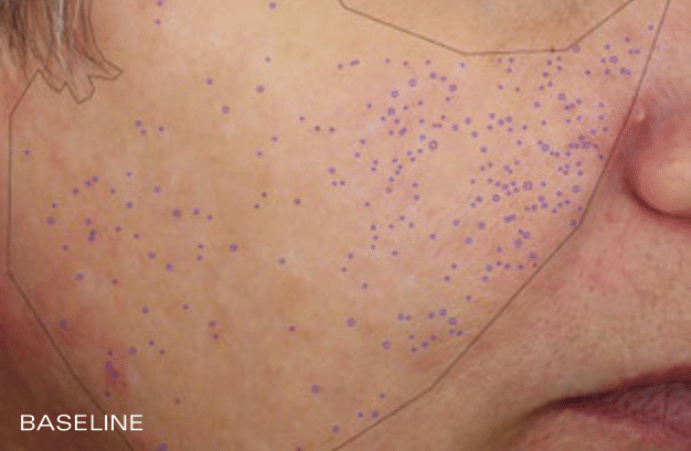 Pore Reduction - Before