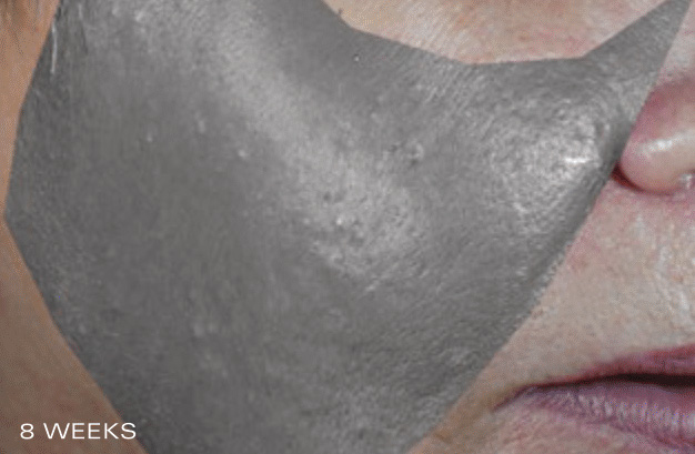 Skin Texture - After