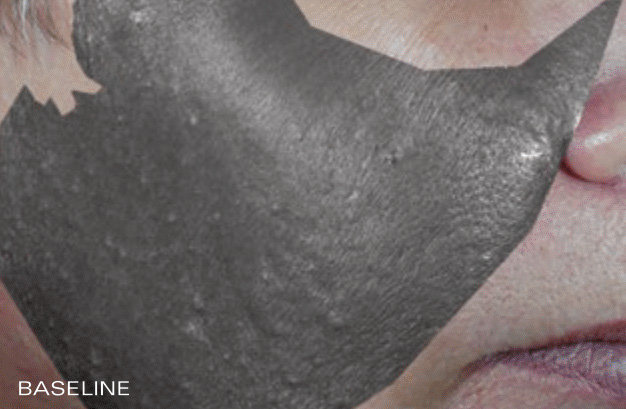 Skin Texture - Before