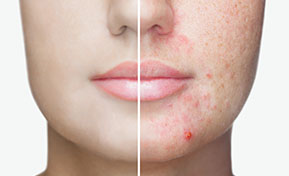 Acne Treatment Mequon WI